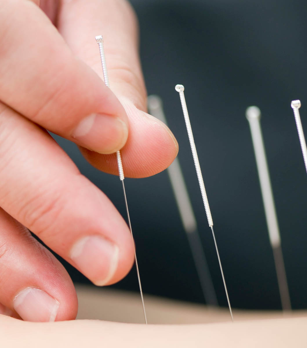 TCM acupuncture treatment