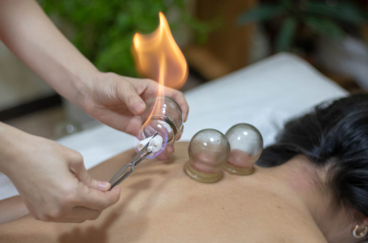 Chinese fire-cupping being performed on lady's back