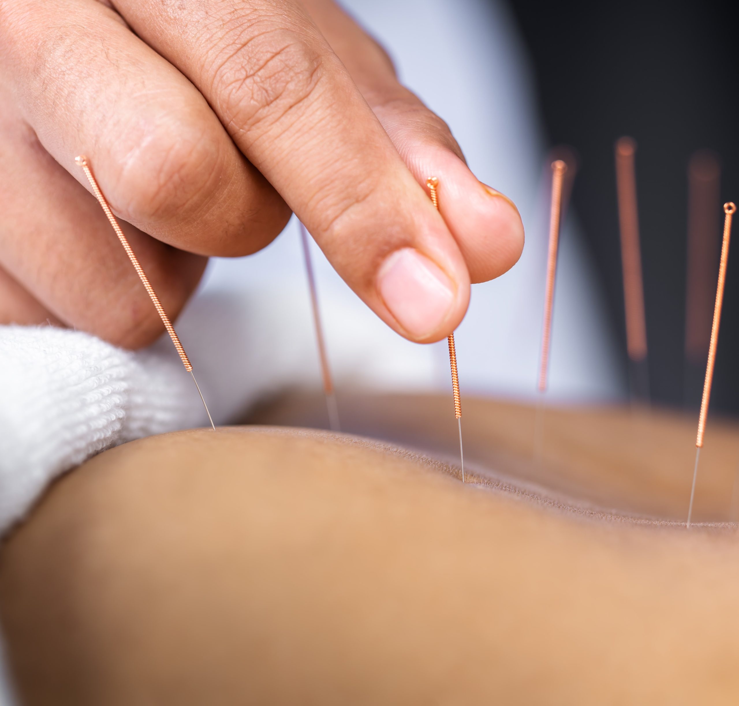 acupuncture being performed on a person