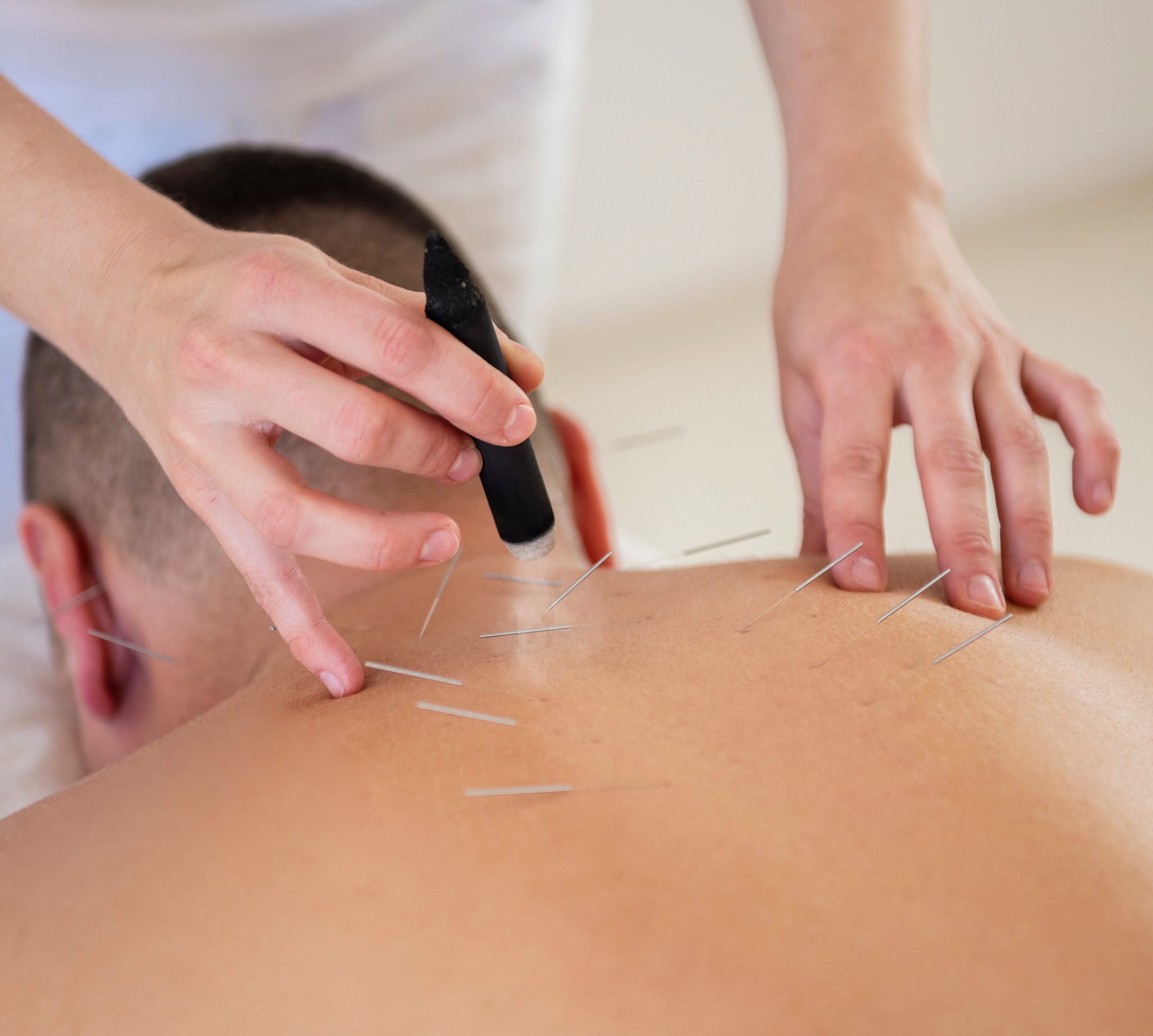 acupuncture and moxibustion treatment on man