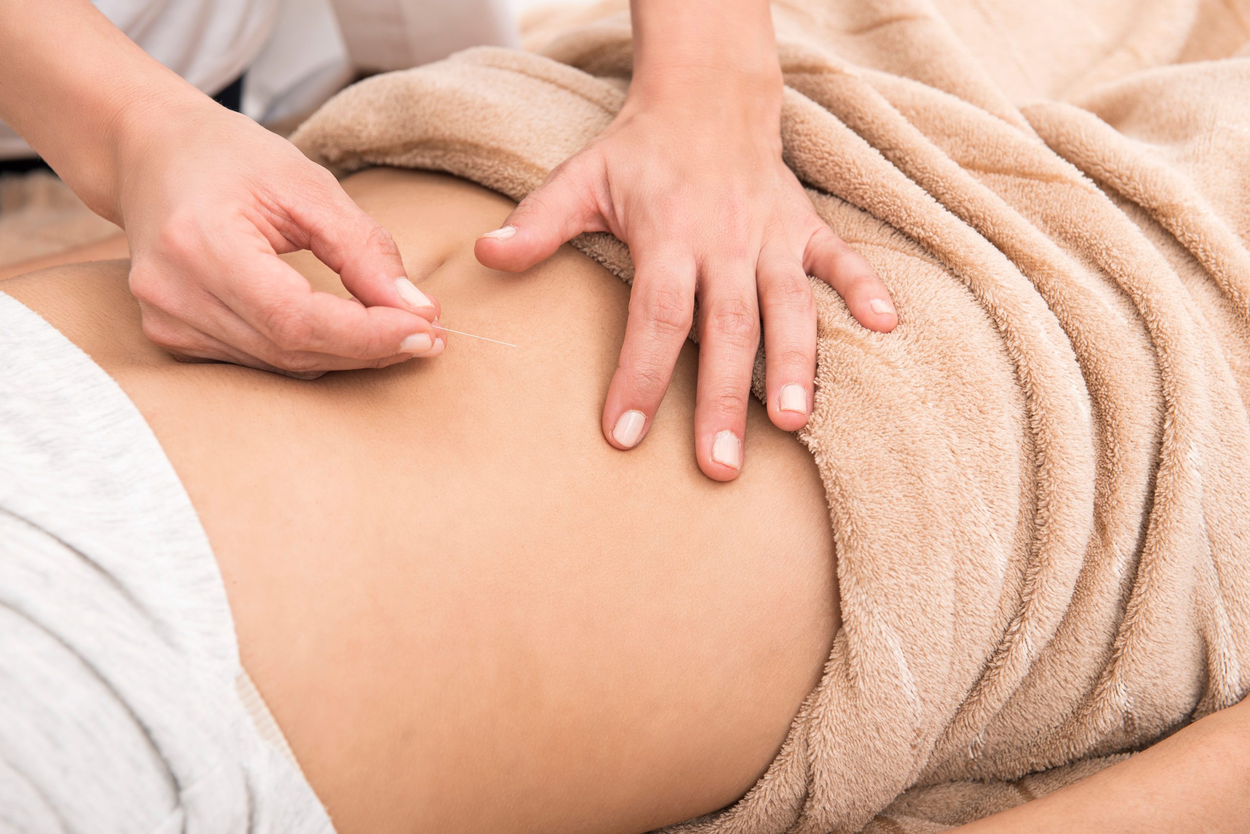 fertility acupuncture treatment on woman